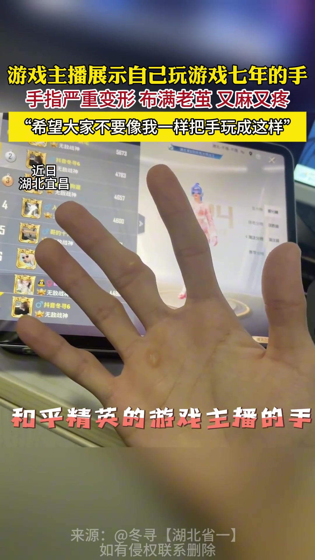 DB视讯官网游戏主播玩游戏7年手指严重变形：每天固定一个动作十几个小时